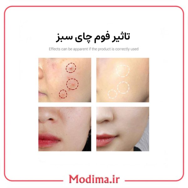 فوم ضد جوش چای سبز هاچانا🌱