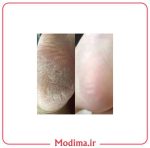 توضیحات اسپری رفع ترک پا و لایه بردار راکو‍