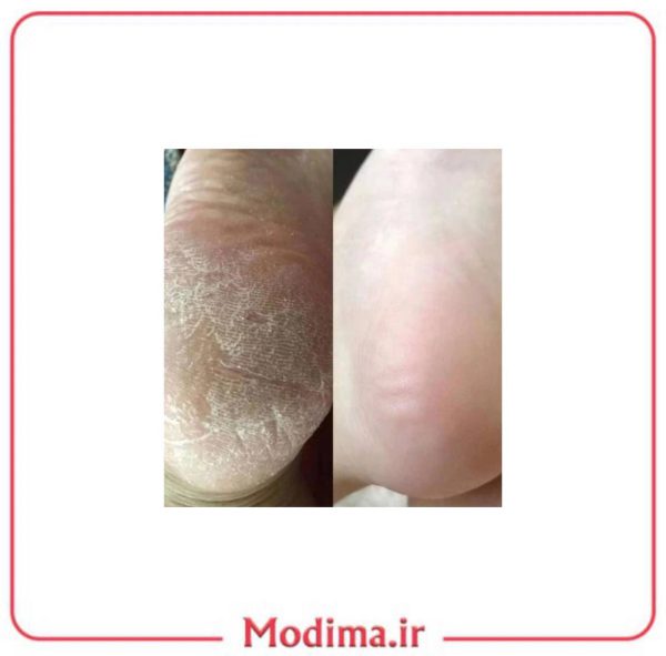 توضیحات اسپری رفع ترک پا و لایه بردار راکو‍