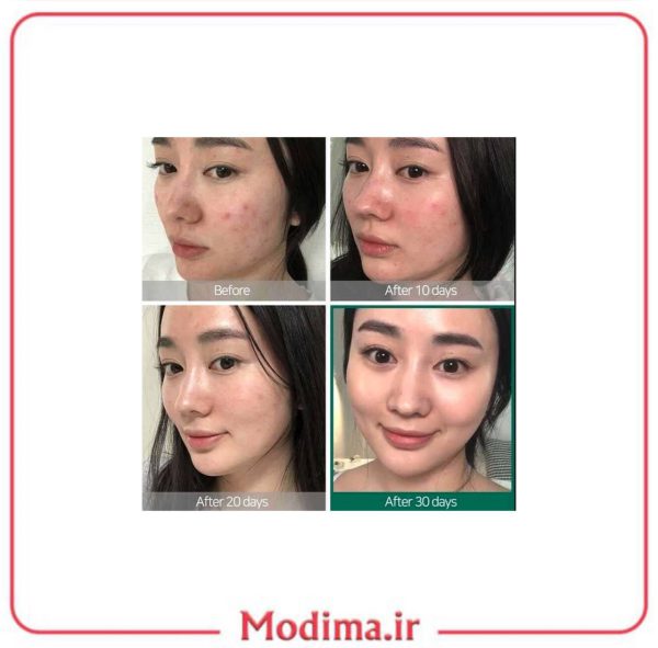 توضیحات پک روتین پوستی ضد جوش 30 روزه